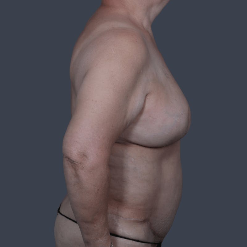 Breast Reconstruction Revision Before & After Gallery - Patient 343087 - Image 4
