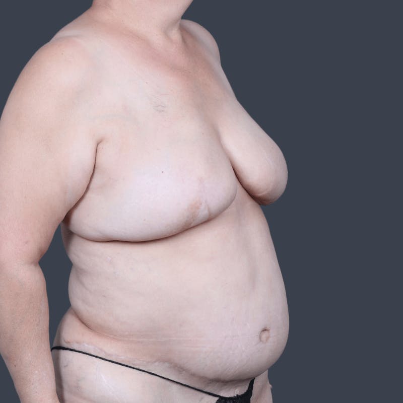 Breast Reconstruction Revision Before & After Gallery - Patient 343087 - Image 5