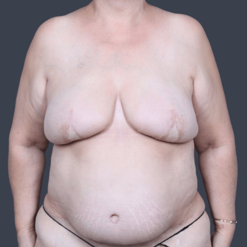 Breast Reconstruction Revision Before & After Gallery - Patient 343087 - Image 1