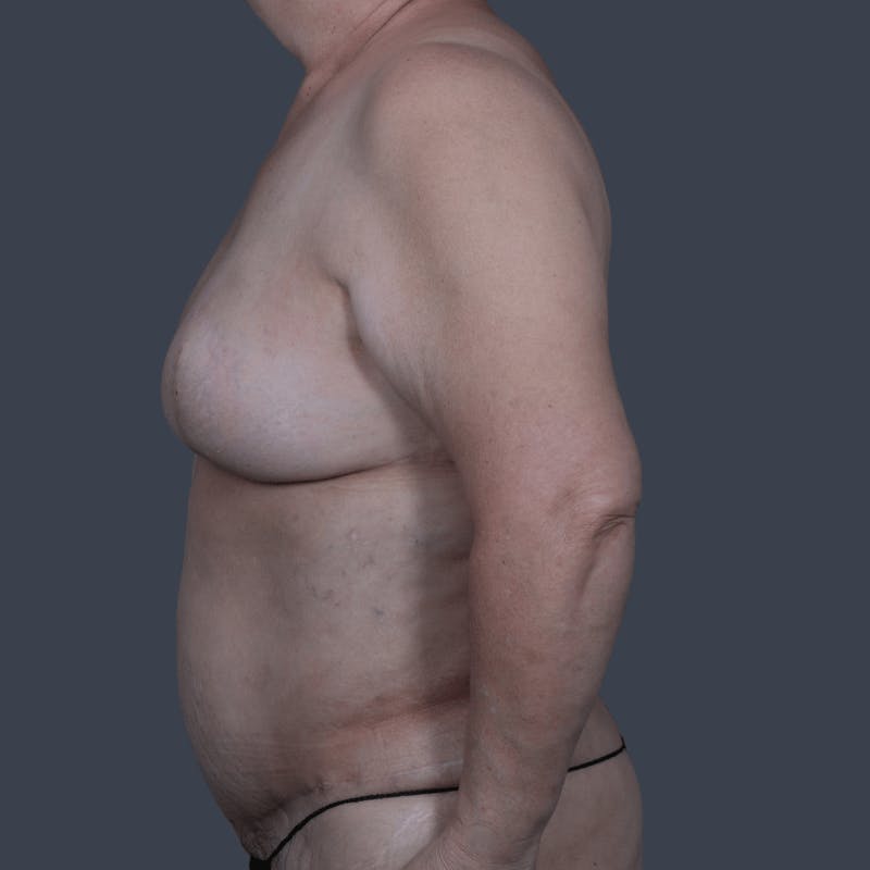 Breast Reconstruction Revision Before & After Gallery - Patient 343087 - Image 10