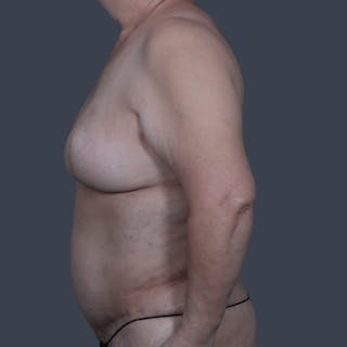 Breast Reconstruction Revision Before & After Gallery - Patient 343087 - Image 10