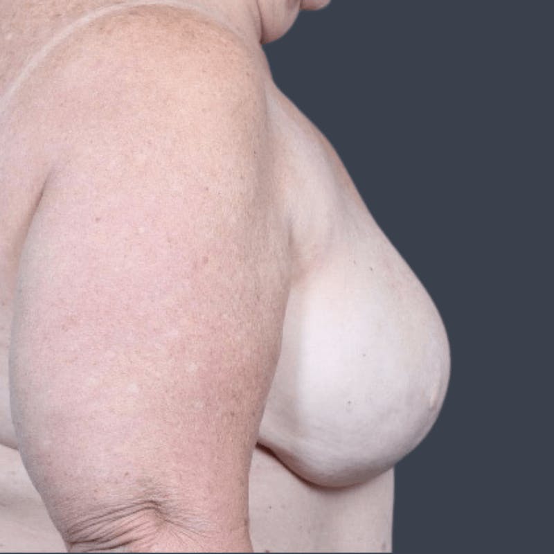 Breast Reconstruction Revision Before & After Gallery - Patient 799158 - Image 5