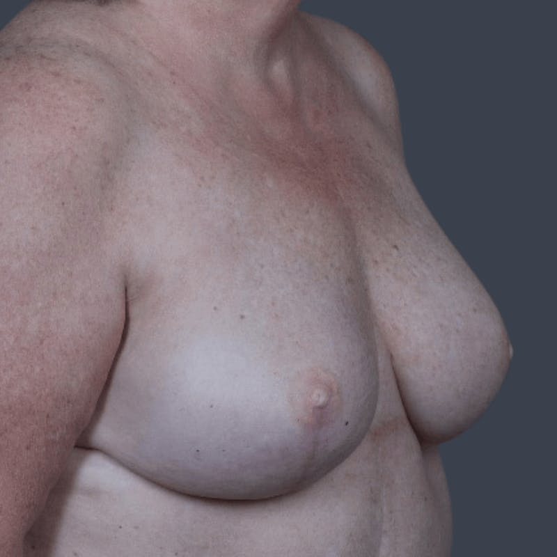 Breast Reconstruction Revision Before & After Gallery - Patient 799158 - Image 4