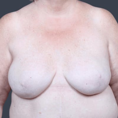 Breast Reconstruction Revision Before & After Gallery - Patient 799158 - Image 1