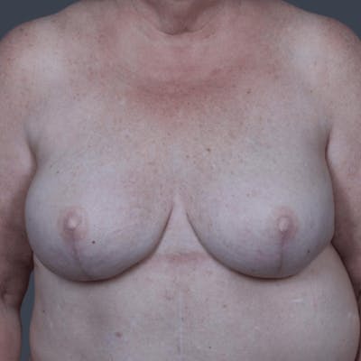 Breast Reconstruction Revision Before & After Gallery - Patient 799158 - Image 2