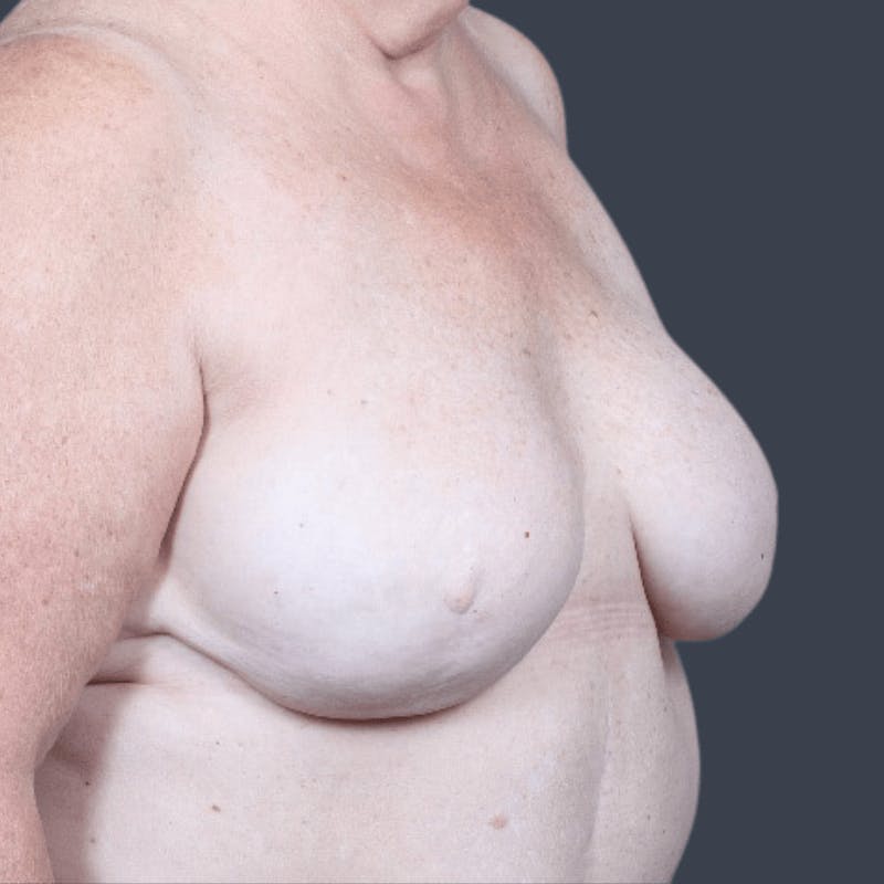 Breast Reconstruction Revision Before & After Gallery - Patient 799158 - Image 3