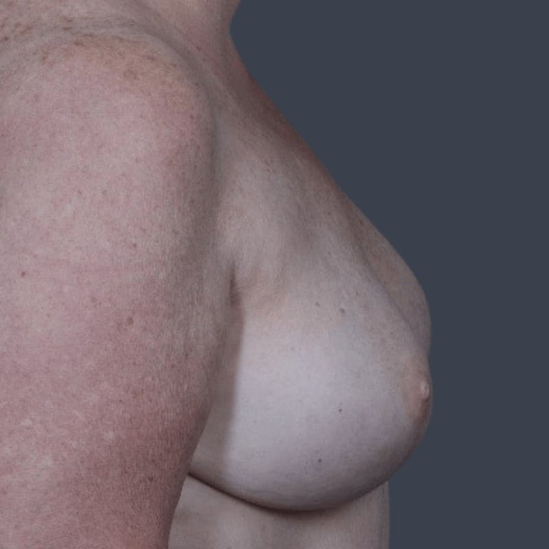 Breast Reconstruction Revision Before & After Gallery - Patient 799158 - Image 6