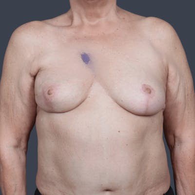 Breast Reconstruction Revision Before & After Gallery - Patient 897632 - Image 2