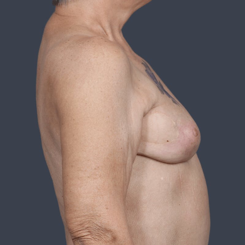 Breast Reconstruction Revision Before & After Gallery - Patient 897632 - Image 4