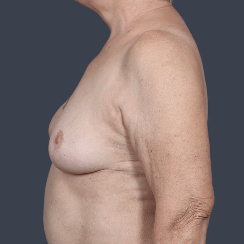 Breast Reconstruction Revision Before & After Gallery - Patient 897632 - Image 8