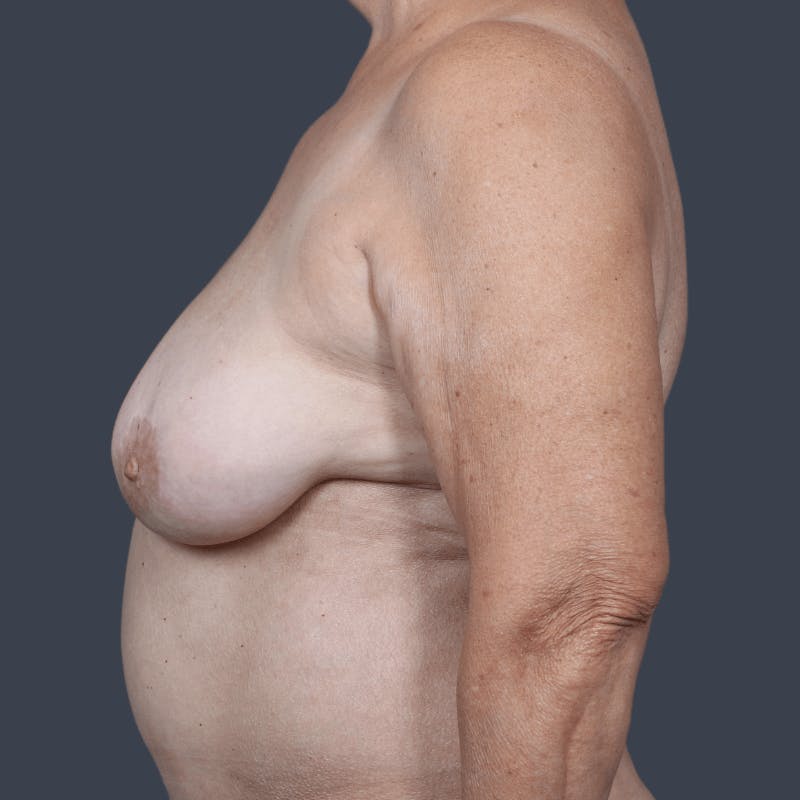 Breast Reconstruction Revision Before & After Gallery - Patient 897632 - Image 7