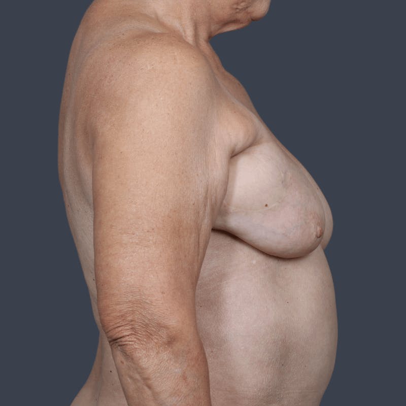 Breast Reconstruction Revision Before & After Gallery - Patient 897632 - Image 3