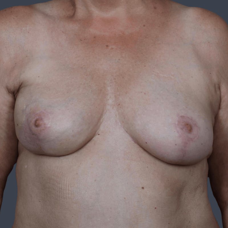 Breast Reconstruction Revision Before & After Gallery - Patient 897632 - Image 10