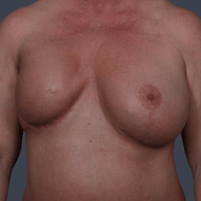 Breast Reconstruction Revision Before & After Gallery - Patient 492803 - Image 1