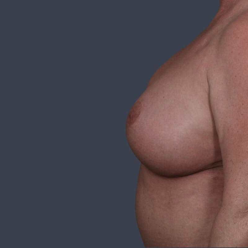 Breast Reconstruction Revision Before & After Gallery - Patient 492803 - Image 5