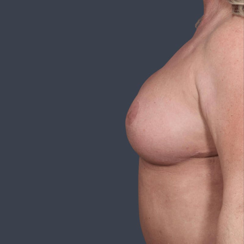 Breast Reconstruction Revision Before & After Gallery - Patient 492803 - Image 6