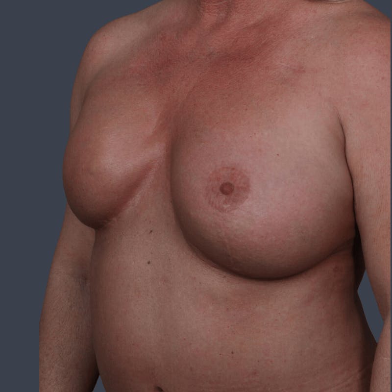 Breast Reconstruction Revision Before & After Gallery - Patient 492803 - Image 3