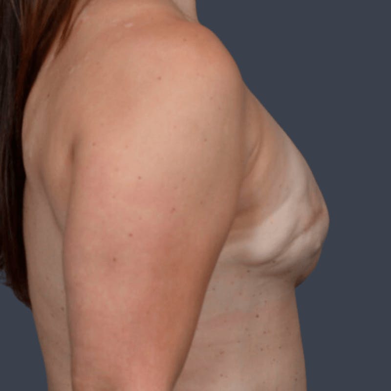 Breast Reconstruction Revision Before & After Gallery - Patient 119561 - Image 5