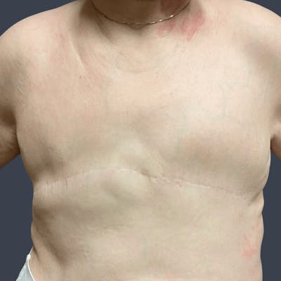 Breast Reconstruction Revision Before & After Gallery - Patient 109757 - Image 2