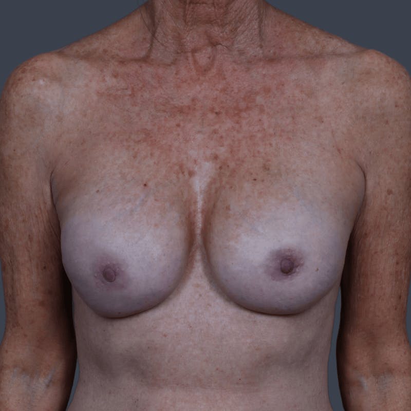 Nipple-Sparing Breast Reconstruction Before & After Gallery - Patient 359511 - Image 2