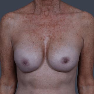 Implant Breast Reconstruction Before & After Gallery - Patient 133171 - Image 2