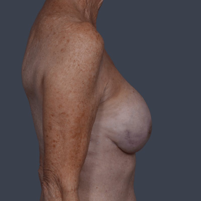Nipple-Sparing Breast Reconstruction Before & After Gallery - Patient 359511 - Image 4