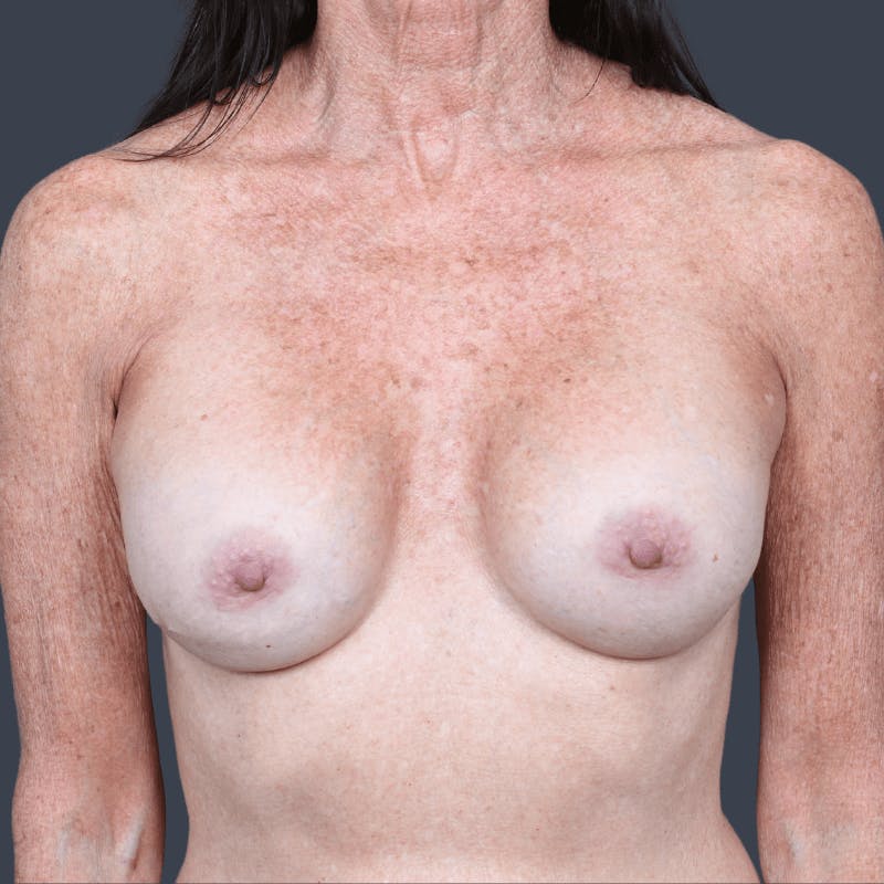Nipple-Sparing Breast Reconstruction Before & After Gallery - Patient 359511 - Image 1