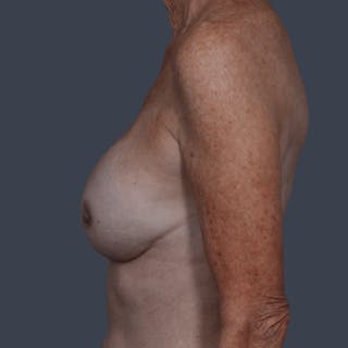 Implant Breast Reconstruction Before & After Gallery - Patient 133171 - Image 10