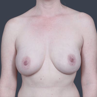 Implant Breast Reconstruction Before & After Gallery - Patient 421547 - Image 2