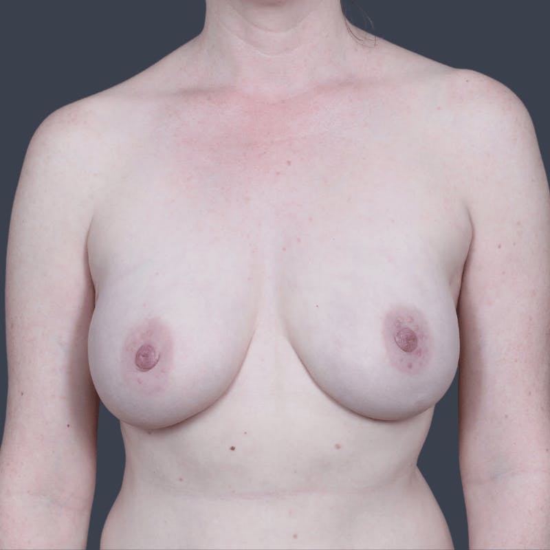 Nipple-Sparing Breast Reconstruction Before & After Gallery - Patient 129638 - Image 2