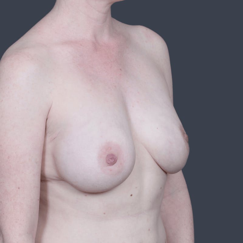 Nipple-Sparing Breast Reconstruction Before & After Gallery - Patient 129638 - Image 6