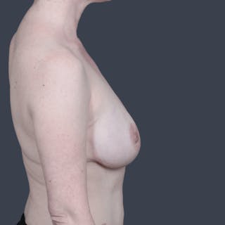 Nipple-Sparing Breast Reconstruction Before & After Gallery - Patient 129638 - Image 4