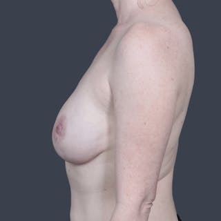 Nipple-Sparing Breast Reconstruction Before & After Gallery - Patient 129638 - Image 10