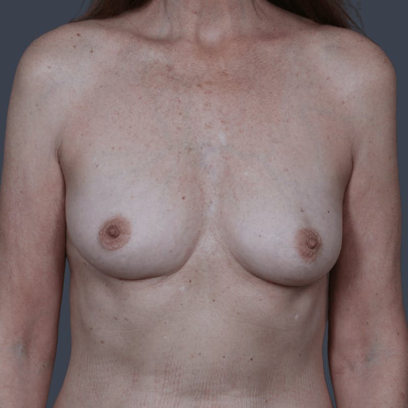 Nipple-Sparing Breast Reconstruction Before & After Gallery - Patient 319799 - Image 1