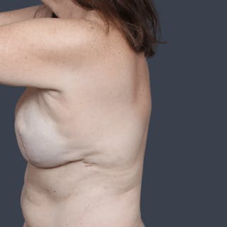 Implant Breast Reconstruction Before & After Gallery - Patient 345487 - Image 6