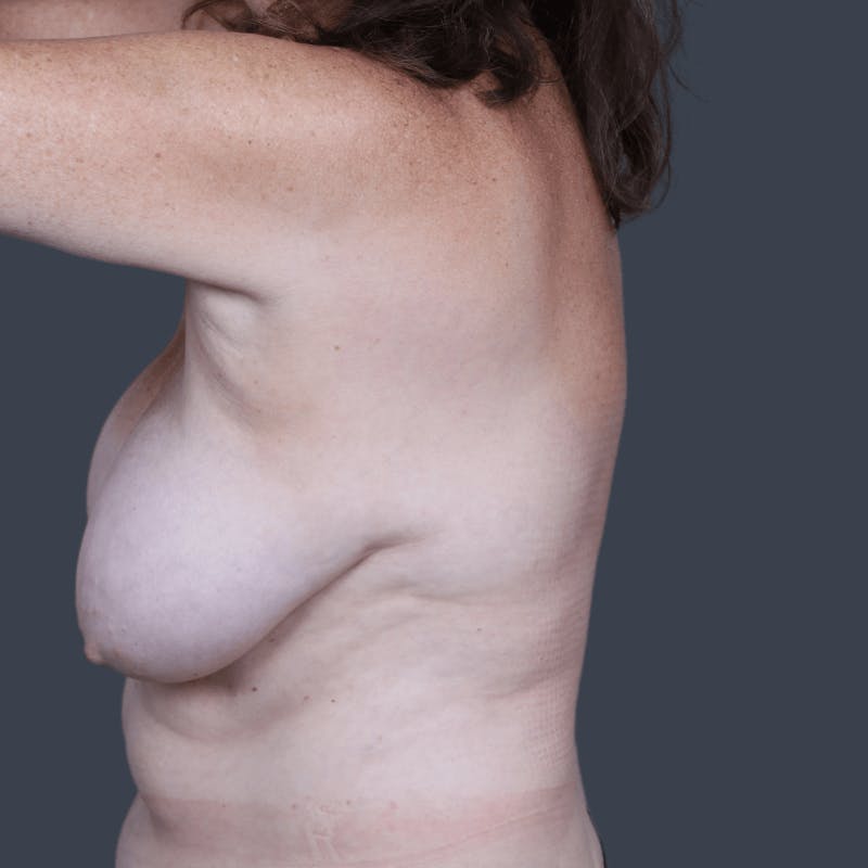 Implant Breast Reconstruction Before & After Gallery - Patient 345487 - Image 5