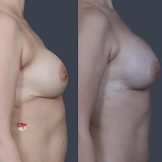 Implant Breast Reconstruction Before & After Gallery - Patient 429071 - Image 6