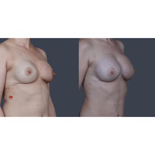 Implant Breast Reconstruction Before & After Gallery - Patient 429071 - Image 4