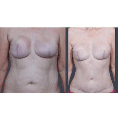 DIEP Flap Before & After Gallery - Patient 365724 - Image 2