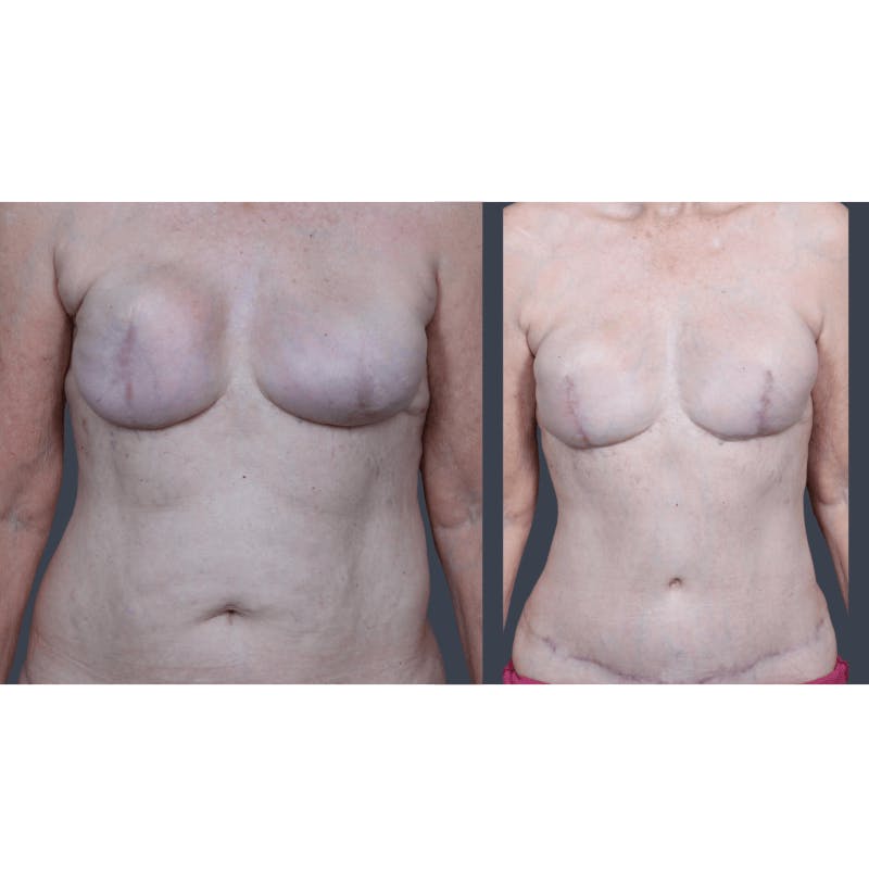 DIEP Flap Before & After Gallery - Patient 365724 - Image 2