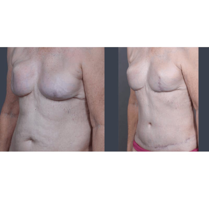DIEP Flap Before & After Gallery - Patient 365724 - Image 4