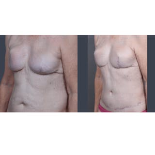 DIEP Flap Before & After Gallery - Patient 365724 - Image 4