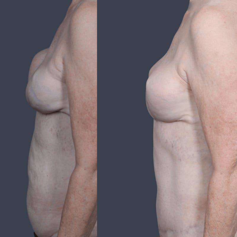 DIEP Flap Before & After Gallery - Patient 365724 - Image 6