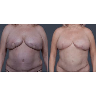 DIEP Flap Before & After Gallery - Patient 353573 - Image 4