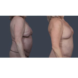 DIEP Flap Before & After Gallery - Patient 353573 - Image 6