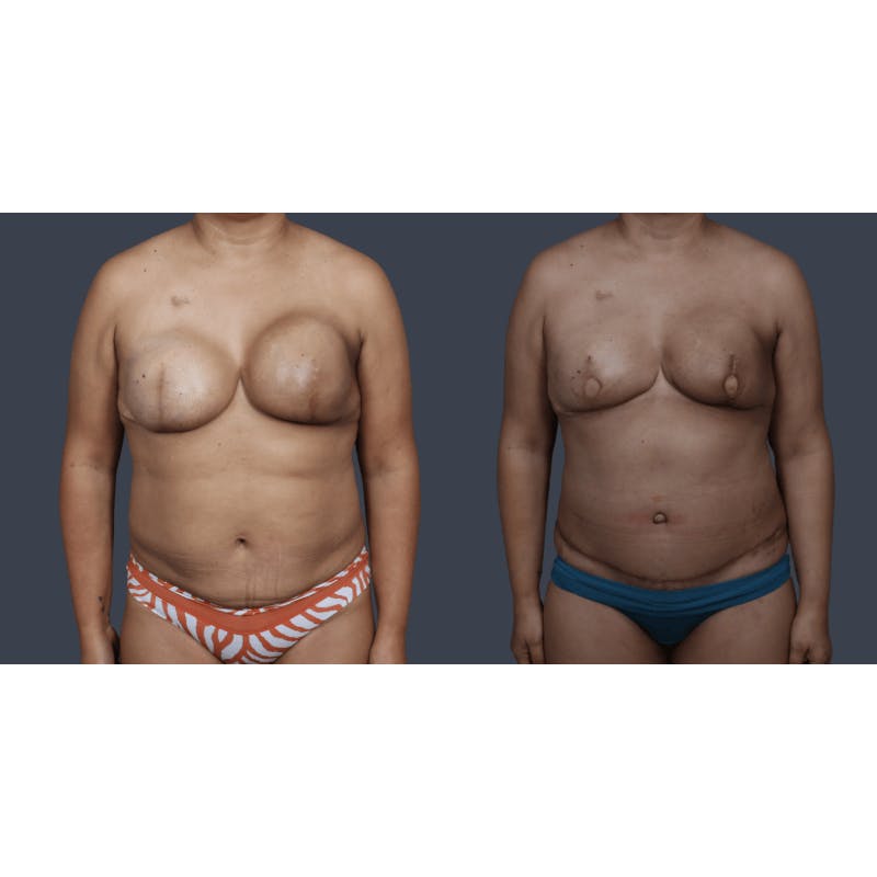 DIEP Flap Before & After Gallery - Patient 151527 - Image 2