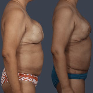 DIEP Flap Before & After Gallery - Patient 151527 - Image 4