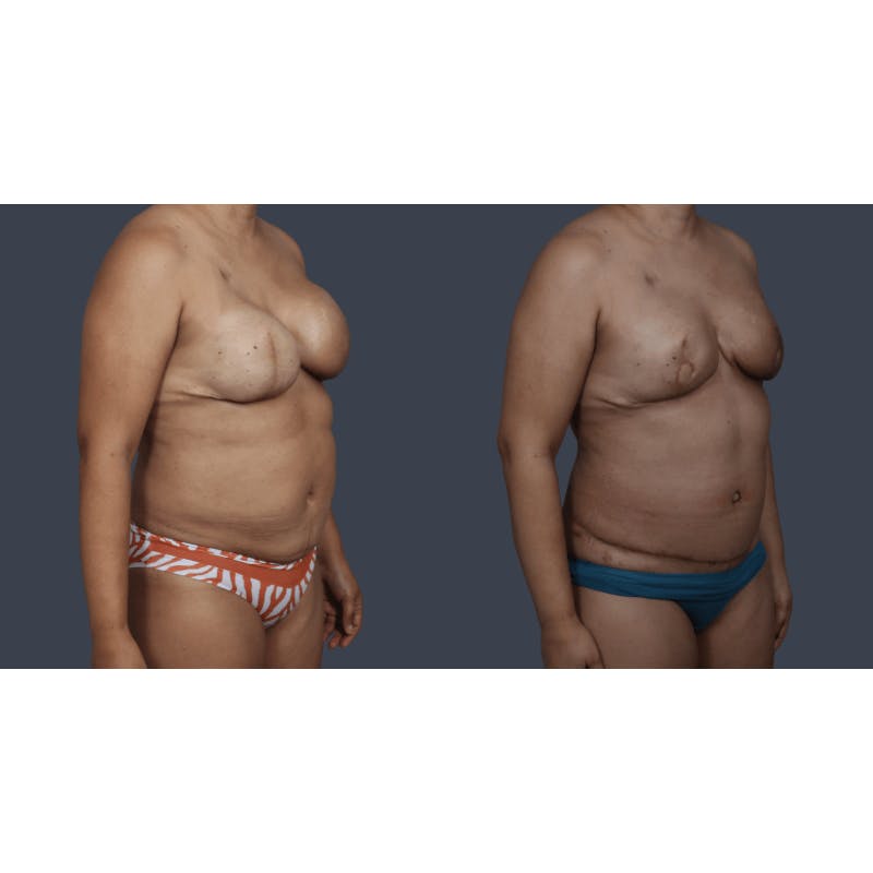 DIEP Flap Before & After Gallery - Patient 151527 - Image 6