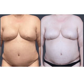 DIEP Flap Before & After Gallery - Patient 331435 - Image 2