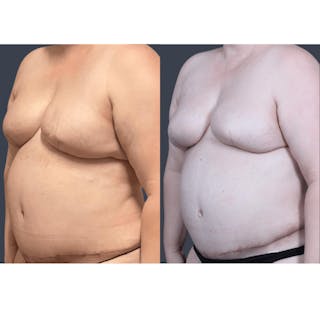 DIEP Flap Before & After Gallery - Patient 331435 - Image 4